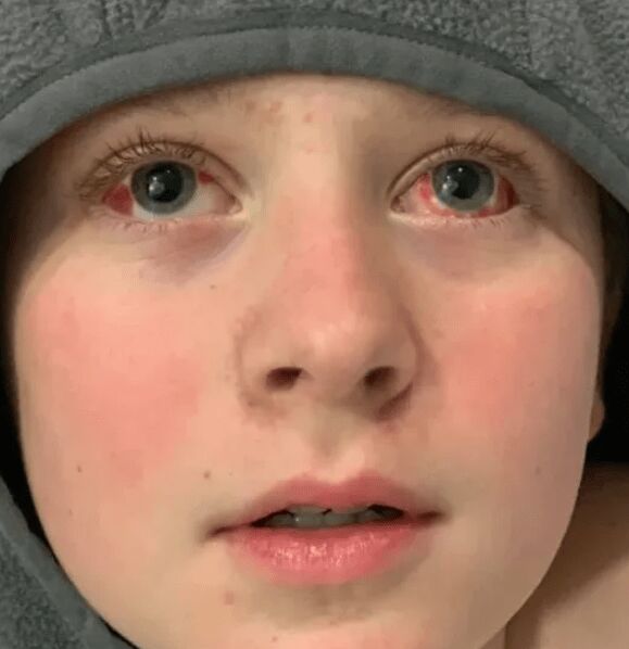 新冠患者症状怪异：11岁男孩手眼变红 双脚变蓝-2.jpeg