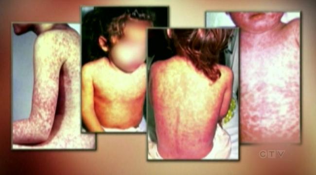 加拿大4省爆病例 30岁男子接种疫苗仍感染